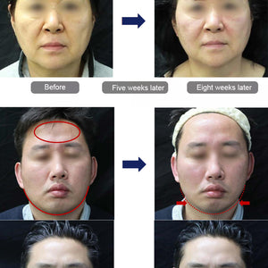 2 in 1 7D HIFU Peninsula Ultrasonix Precise Anti-aging  healing head RF Decives