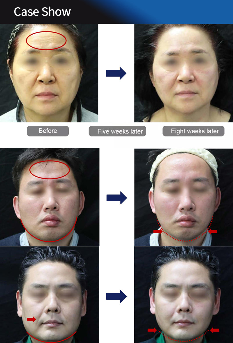 2 in 1 7D HIFU Peninsula Ultrasonix Precise Anti-aging  healing head RF Decives