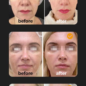 Double handle 7D HIFU Facial Lifting Device With 7 Cartridges