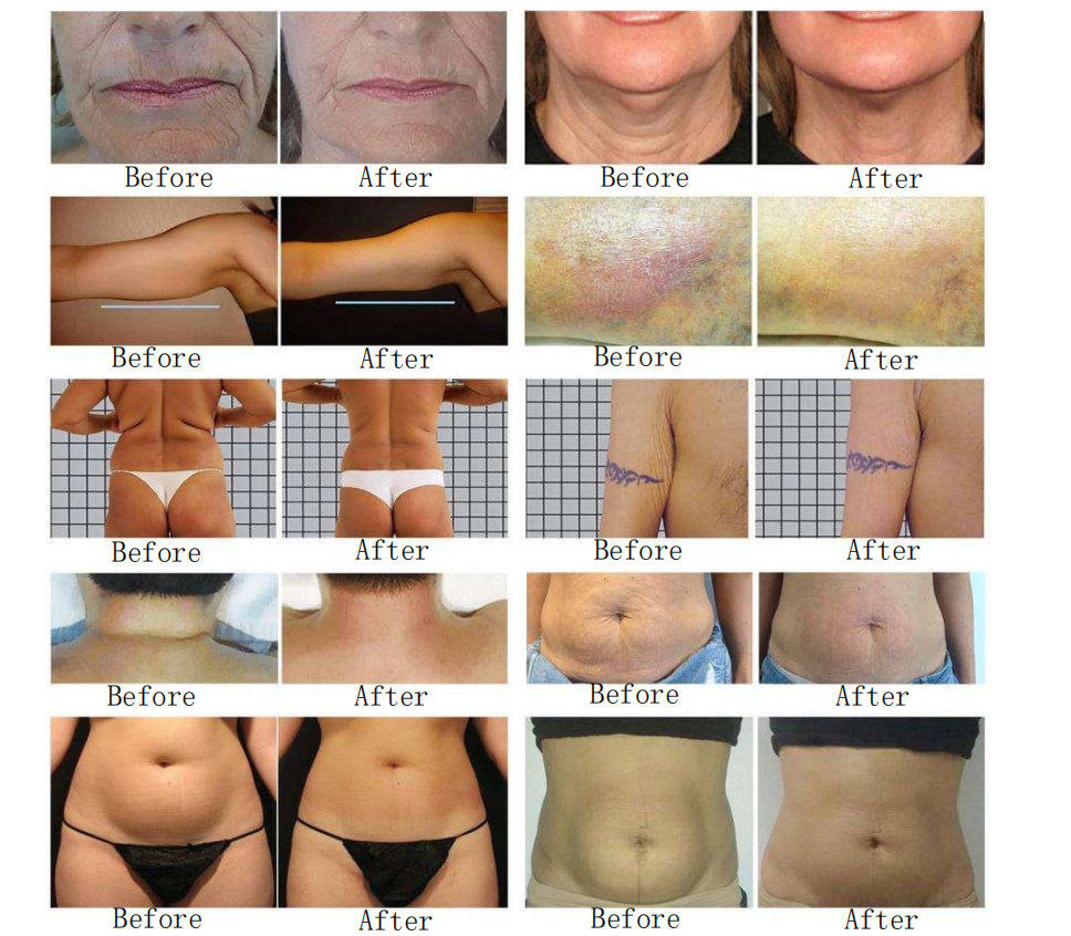 Rotary Negative Pressure RF Machine With Liposuction Handle Non-invasive Decive