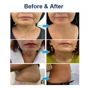 Double handle 7D HIFU Facial Lifting Device With 7 Cartridges