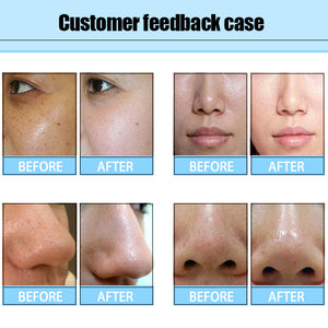 Hydro Dermabrasion Facial Machine Peel Diamond Peeling Machine