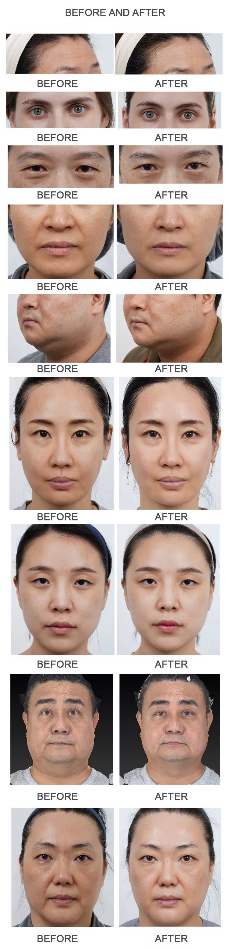 Latest  HIFU Ultra Booster pen circular 3 handles Anti-aging Machine