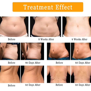 Vertical Cryolipolysis Freezing Weight Loss Machine