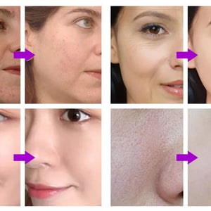 Vacuum Face Clean Hydro Water Oxygen jet Facial Ance Pore Cleaner Skin Care Machine