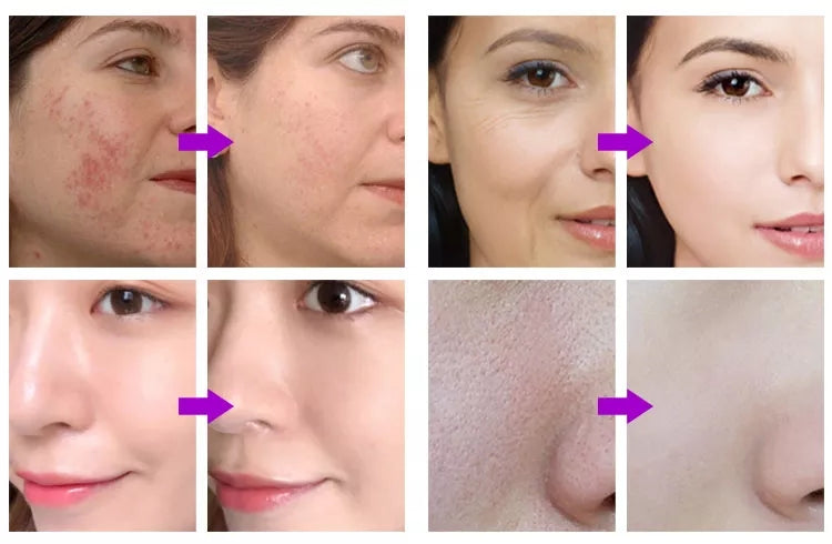 Vacuum Face Clean Hydro Water Oxygen jet Facial Ance Pore Cleaner Skin Care Machine