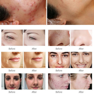 Hydro Water 14 in 1 Oxygen Jet Peel Facial Beauty deeping Clean Skin Device