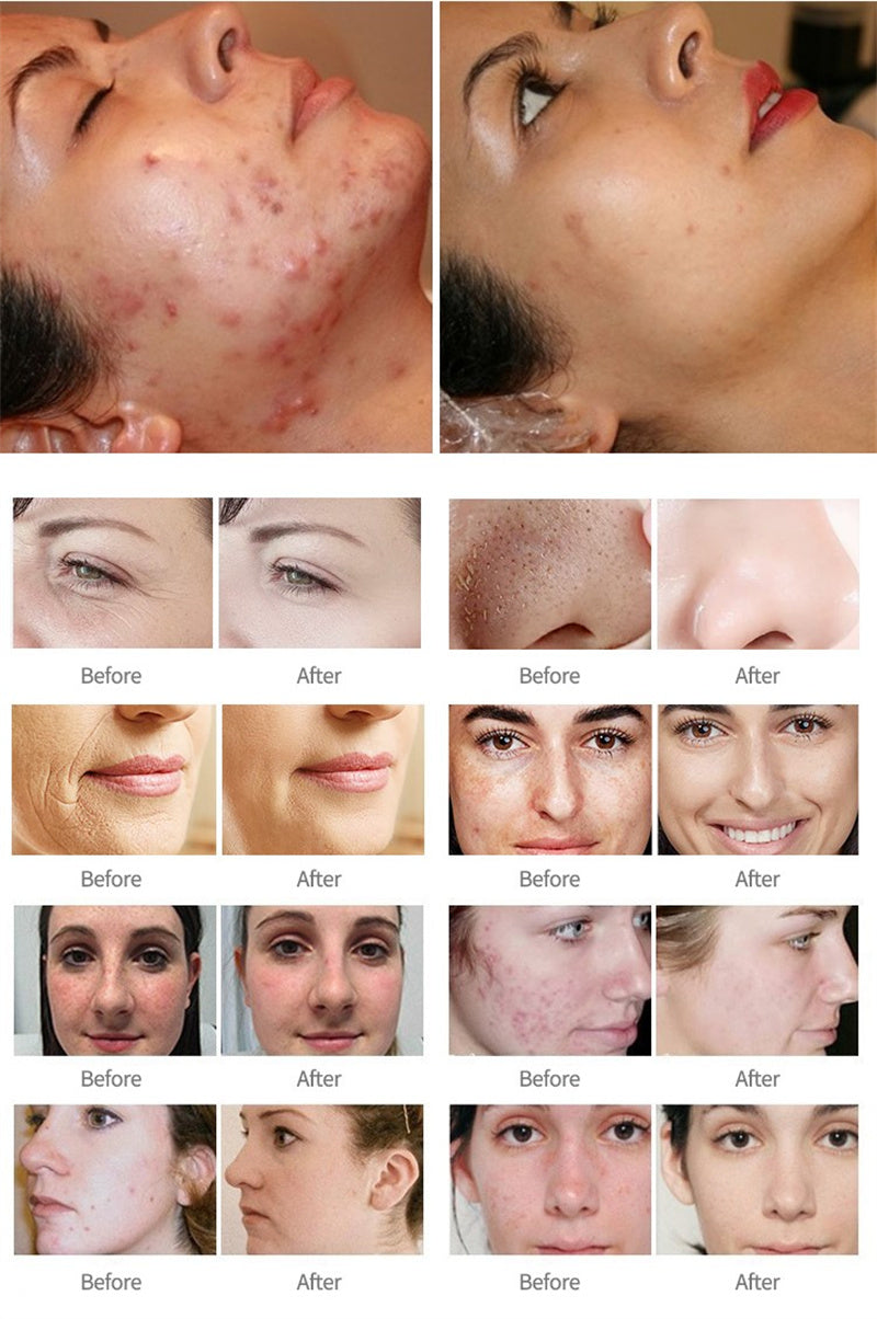 Hydro Water 14 in 1 Oxygen Jet Peel Facial Beauty deeping Clean Skin Device