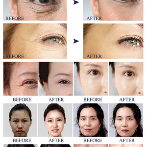 Skin Care Device Face Lifting Wrinkle Removal Eye Care RF Skin Tightening Machine