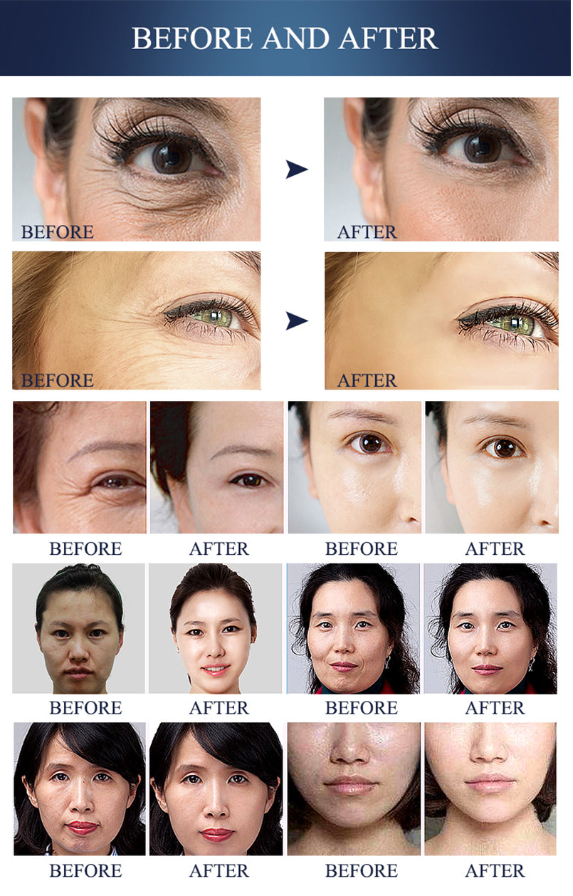 Skin Care Device Face Lifting Wrinkle Removal Eye Care RF Skin Tightening Machine