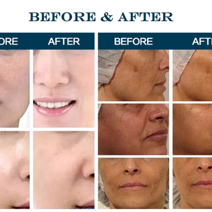 7 in 1 Microdermabrasion Ultrasonic RF BIO Hydro Dermabrasion Hydro Facial Machine