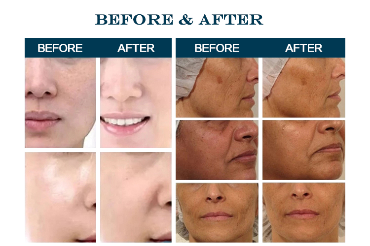 7 in 1 Microdermabrasion Ultrasonic RF BIO Hydro Dermabrasion Hydro Facial Machine