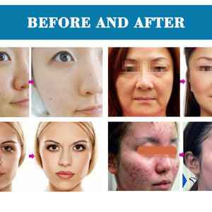 6 in 1 Aqua Facial Cleaning Hydro micro dermabrasion professional machine