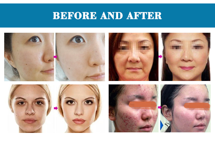 6 in 1 Aqua Facial Cleaning Hydro micro dermabrasion professional machine