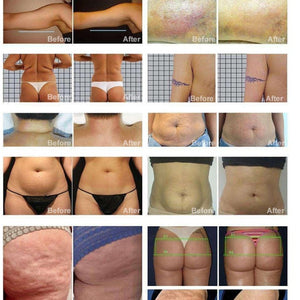 Good Price Roller Massage Vibrating Cellulite Remove Slimsphere Therapy Roller Machin