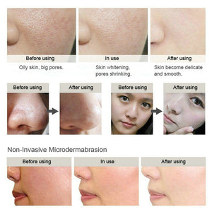 3 in 1 Diamond Microdermabrasion SPA Skin Rejuvenation Exfoliating Equipment