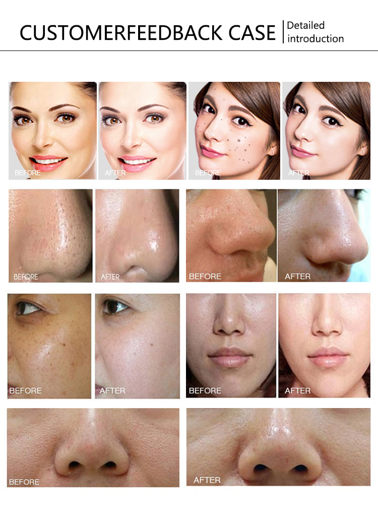 10 in 1 Hydro Oxygen Deep Clean Oxygen Jet Ultrasound RF Skin Oxygen Facial Machine