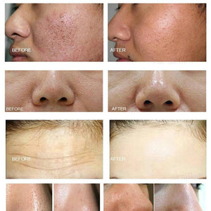 10 in 1 Skin Peeling Facial Care Machine Face Lift Skin Tightening Treatment Machine