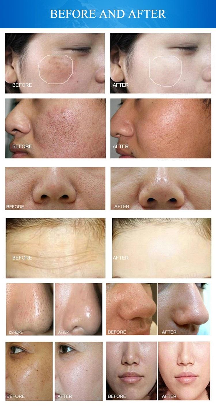 10 in 1 Skin Peeling Facial Care Machine Face Lift Skin Tightening Treatment Machine