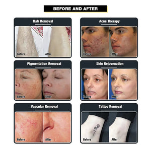 Customizable Oem Odm Non-invasive Hair Removal Permanent Hair Removal Machine