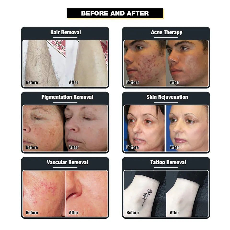 Customizable Oem Odm Non-invasive Hair Removal Permanent Hair Removal Machine