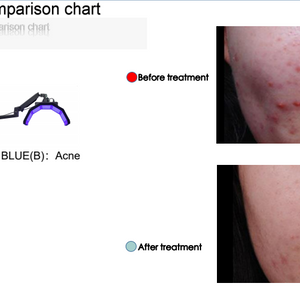 Vertical Led Light Therapy Professional Beauty Equipment PDT Led Light Therapy