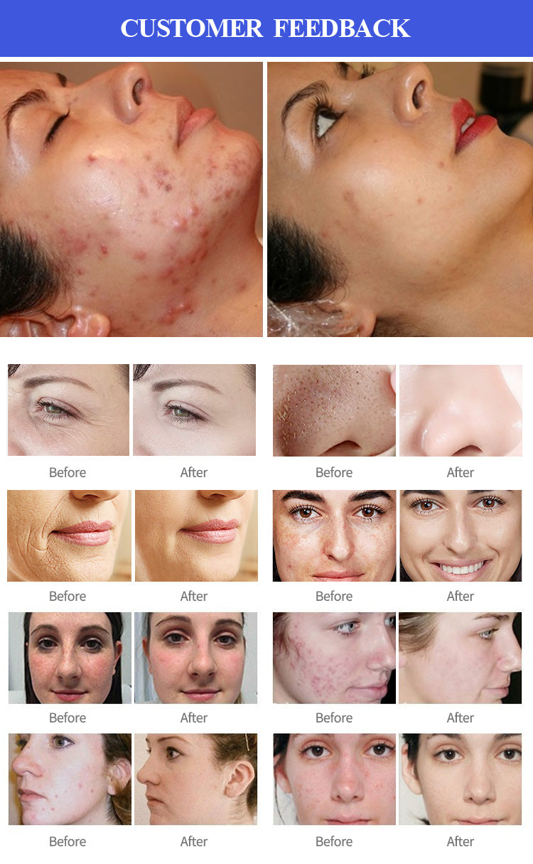 12 In 1 Alice Bubble Peptide Facial Peeling Hydro Skin Care Beauty Machine