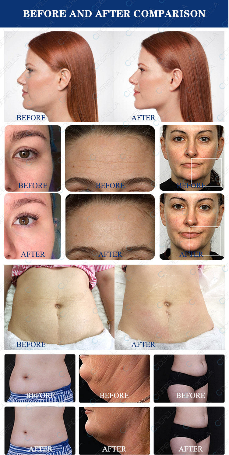 8 in 1 40k Ultrasound Cavitation Body Sculpting machine