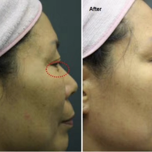 Plasma skin rejuvenation medical facial lifting beauty machine