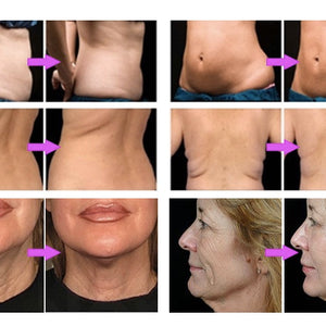 2 in 1 4D Hifu Lipo Sonix Body Slimming Skin Tightening Machine