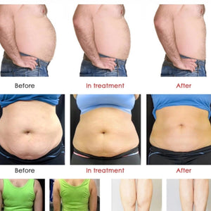 Velashape X8 body contouring slimming machine