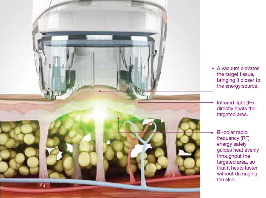 V8L 4 In 1 Body Contouring Effective Weight Loss Beauty Equipment