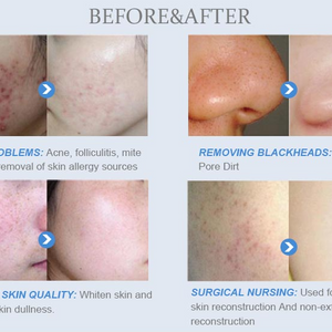 Spa660 Ultrasonic Hydrating Facial Microdermabrasion Machine Skin Care Machine