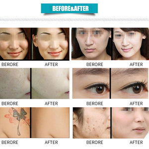 Professional  painless OPT IPL Vertical Hair Removal Machine