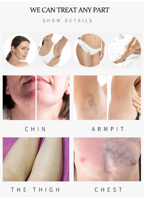 Professional painless 1600w diode laser hair removal Machine