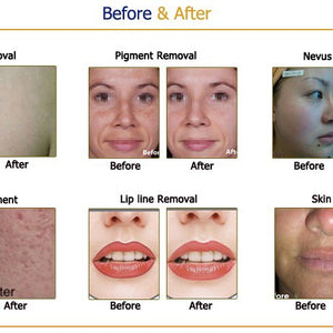 Black Vertical Picosecond Laser Tattoo Removal Pigmentation Therapy Device