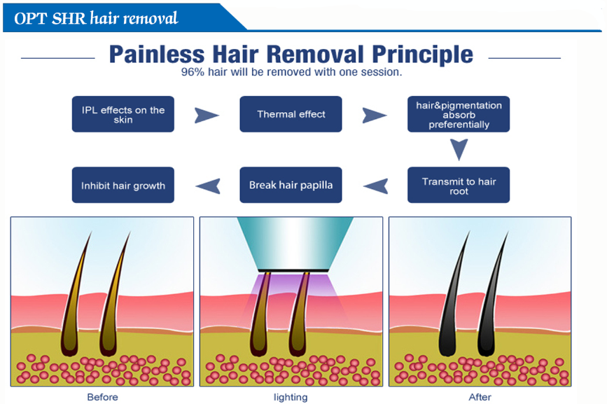 3 In 1 Professional  painless OPT IPL Vertical Hair Removal Machine