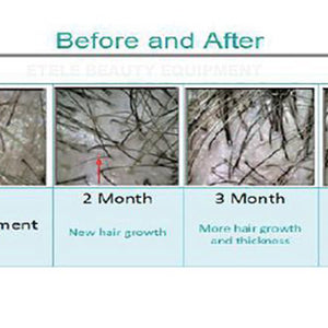 Laser pdt light therapy/anti-hair loss and skin rejuvenation machine