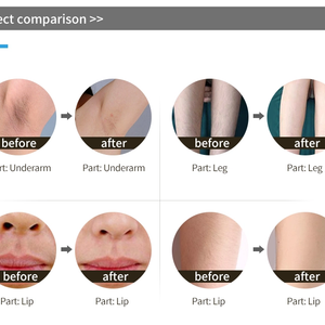 2 in 1 diode laser hair removal machine picosecond pigments removal machine