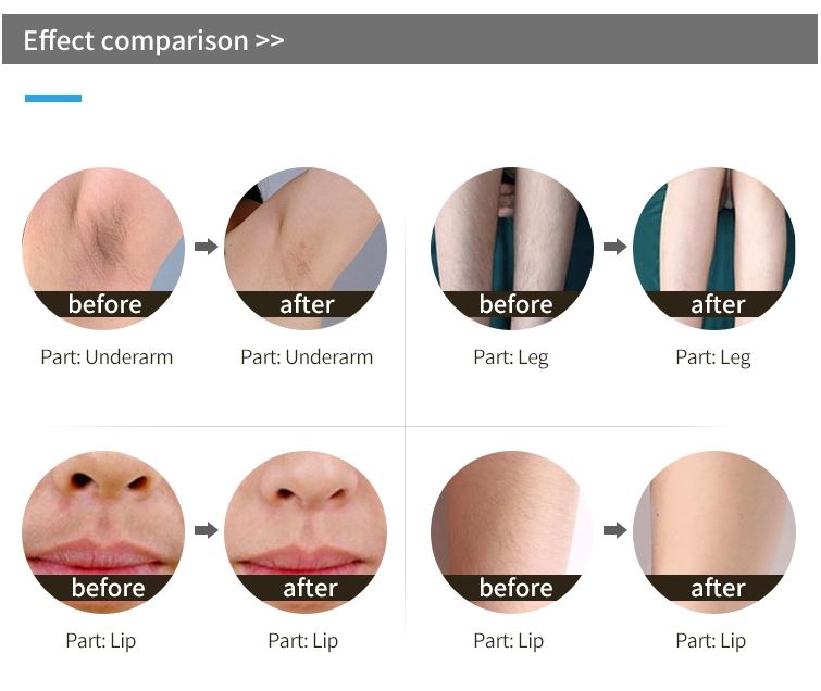 2 in 1 diode laser hair removal machine picosecond pigments removal machine